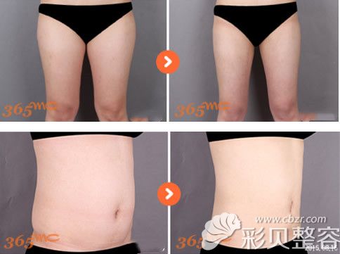 大腿吸脂和腰部吸脂前后效果對比圖