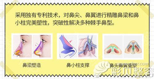 隆鼻示意圖 隆鼻示意圖