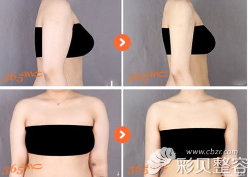 蝴蝶袖吸脂前后正面?zhèn)让鎸Ρ葓D