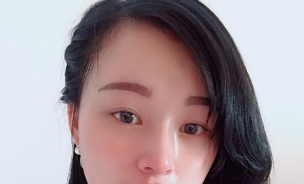 我只做了硅膠假體隆鼻沒有墊鼻尖花了8000塊,大家看值不值？