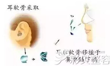 取耳軟骨示意圖
