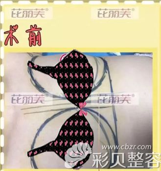 曼托假體隆胸前