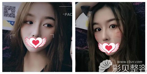 假體隆鼻2個(gè)月沒(méi)有發(fā)現(xiàn)疤痕增生、鼻歪等現(xiàn)象