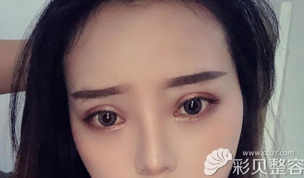 切開(kāi)雙眼皮加開(kāi)眼角三個(gè)月的恢復(fù)效果圖