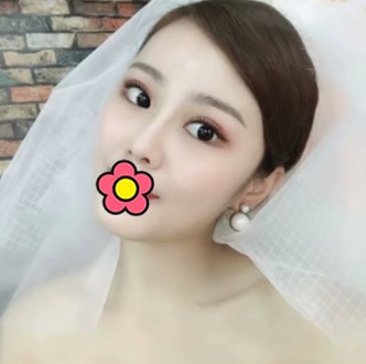 縮小鼻頭鼻翼千萬(wàn)別做!我只做了硅膠耳軟骨隆鼻,鼻子就小了