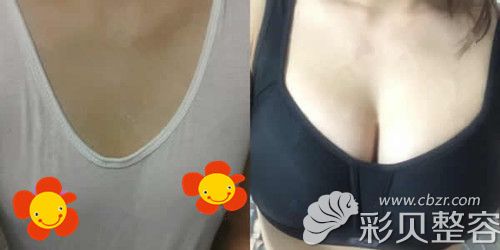 蓓拉假體隆胸275cc效果圖 蓓拉假體隆胸275cc效果圖