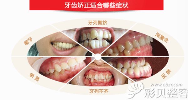 哪些牙齒需要矯正