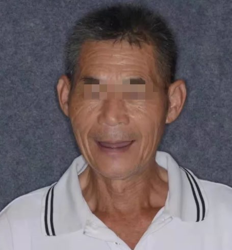 案例:60多歲全口牙缺失的張爺爺,做德國(guó)4D種植牙的真實(shí)感受