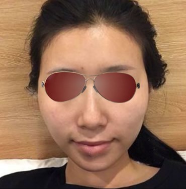 面部提升案例:意大利悅升線做完10天,我下垂的蘋果肌不見了!