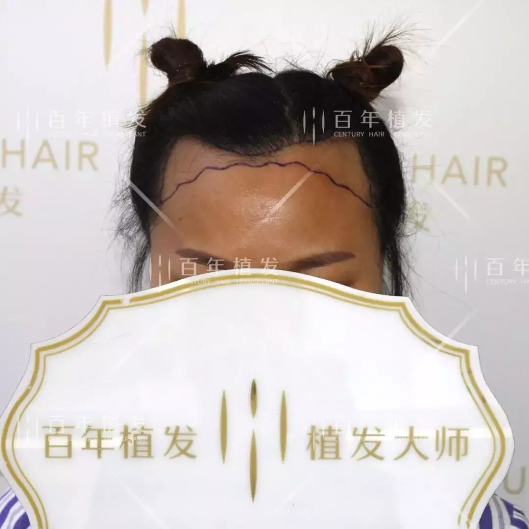 額角種植2000單位，形象氣質(zhì)雙加分！
