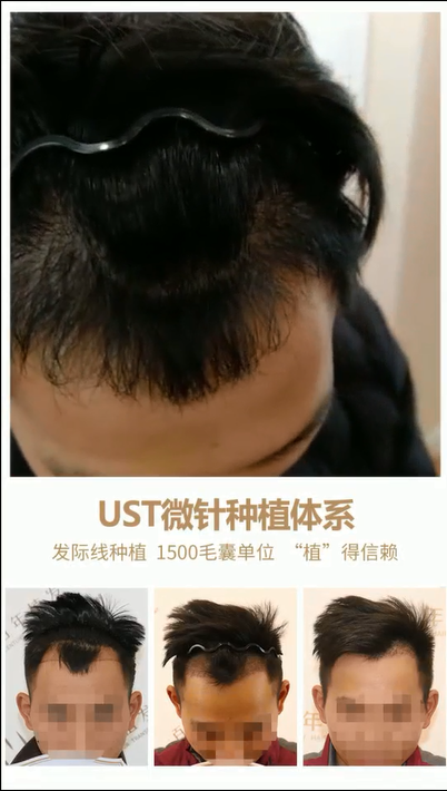 發(fā)際線種植術(shù)后3個(gè)月效果