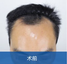 我是三級脫發(fā),用PM+FUE植發(fā)2500毛囊單位,花了3萬多,效果很滿意