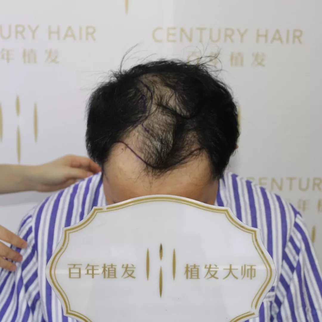 UST-E技術(shù)種植2800單位，還您應(yīng)有帥氣自信