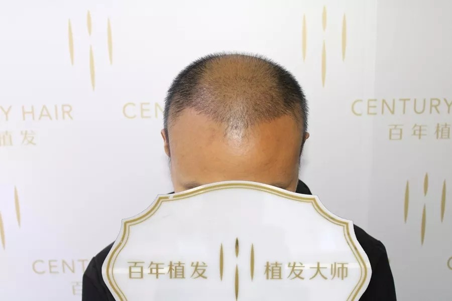 FUE-3.0技術(shù)種植2000單位，成功改善大面積脫發(fā)