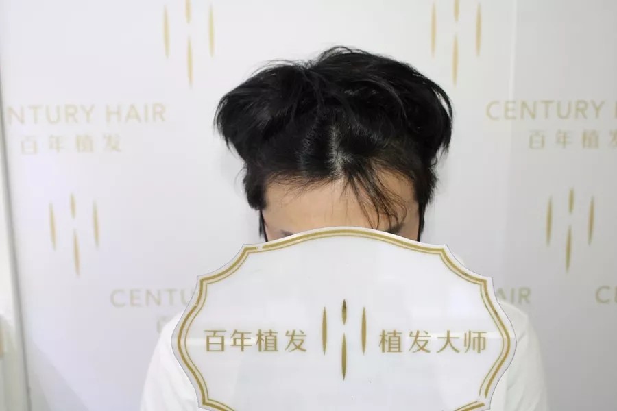 不剃發(fā)種植技術(shù)，助您輕松擺脫術(shù)后尷尬