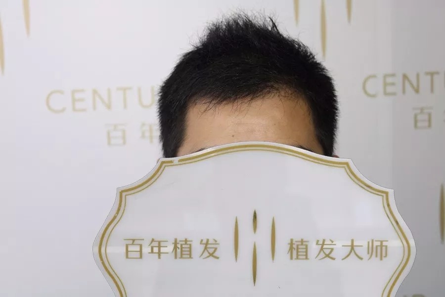 他在百年種植1700毛囊單位，植出3000單位效果！