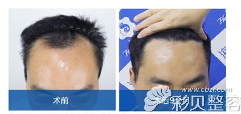 脂溢性脫發(fā)植發(fā)前后對(duì)比