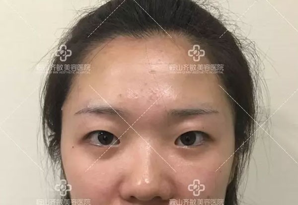 快來聽聽我割雙眼皮不變丑、不后悔的原因及恢復(fù)過程吧！