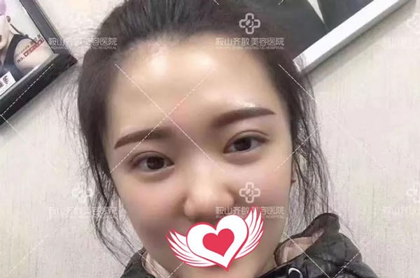 快來聽聽我割雙眼皮不變丑、不后悔的原因及恢復(fù)過程吧！