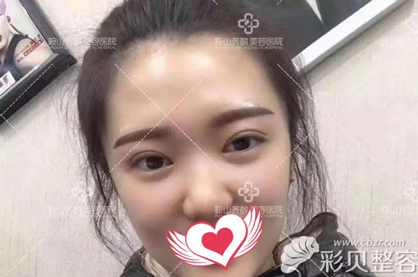 割雙眼皮一個(gè)月的恢復(fù)效果圖