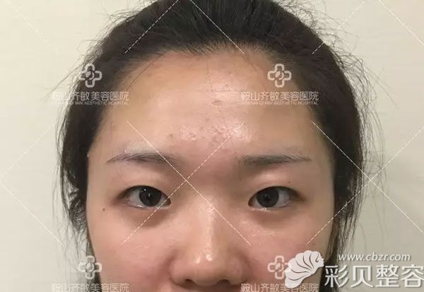全切雙眼皮手術(shù)前
