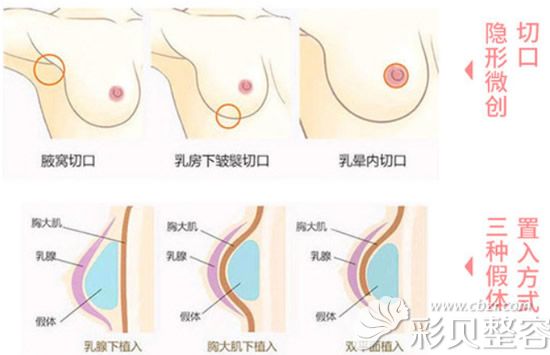 假體豐胸手術(shù)切口和植入方式