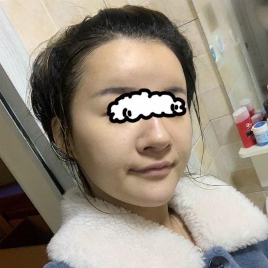 我花4萬(wàn)元做了半肋骨加膨體隆鼻,一年后鼻子沒(méi)有變矮很多