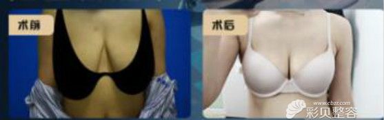 不開刀人工韌帶乳房上提手術(shù)三個(gè)月效果對比圖
