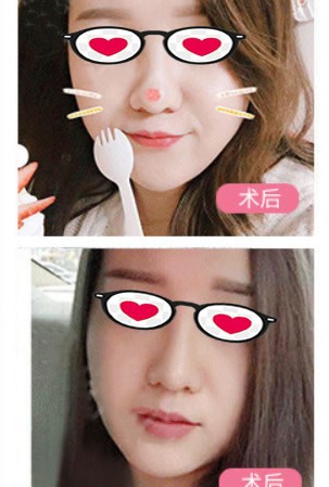 面部抽脂10天臉就下垂松弛了,嚇?biāo)牢伊?但一年后效果蠻好的!