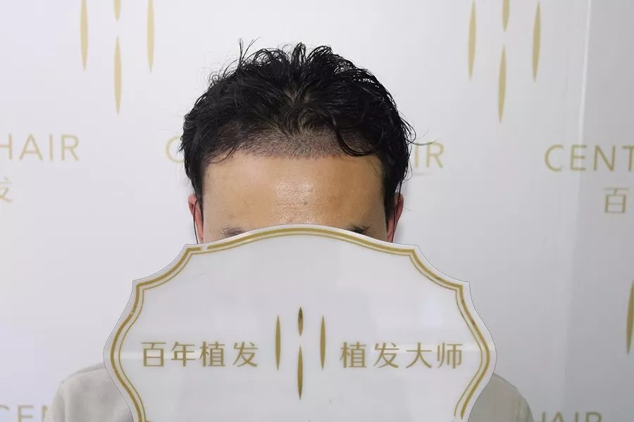 額角種植2580單位，他從八分帥升級(jí)為十分帥！