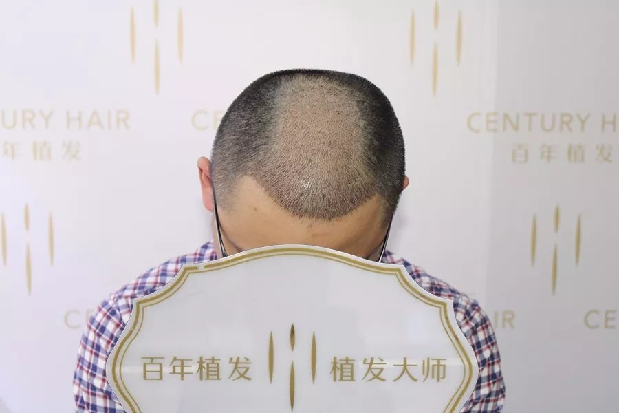 不顧老婆阻攔他堅(jiān)持植發(fā)，結(jié)果令人大感意外