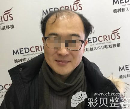 植發(fā)前照片