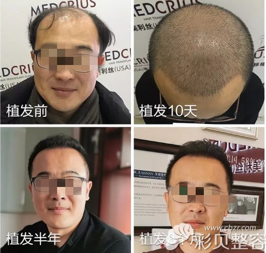 級脫發(fā)植發(fā)效果圖