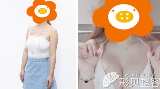 我做乳房下垂矯正前后對(duì)比圖