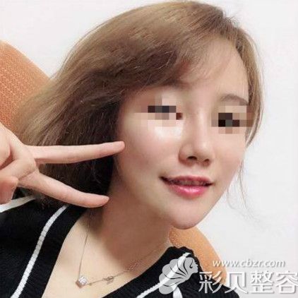 鼻骨內(nèi)推24天鼻子照片