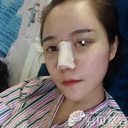 鼻骨內(nèi)推后7天圖片