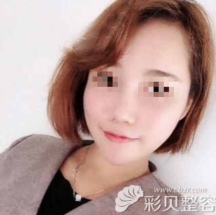做完鼻骨內(nèi)推和鼻中隔耳軟骨隆鼻手術后三個月效果圖