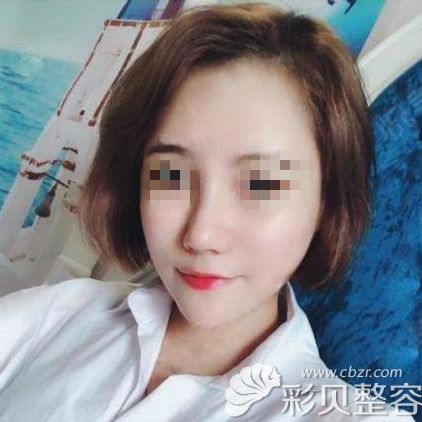 做鼻骨內(nèi)推+鼻中隔耳軟骨隆鼻術后第15天
