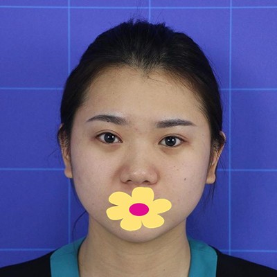 我的半肋骨加膨體隆鼻經(jīng)歷：手術(shù)花了4萬(wàn)元這有前后對(duì)比圖