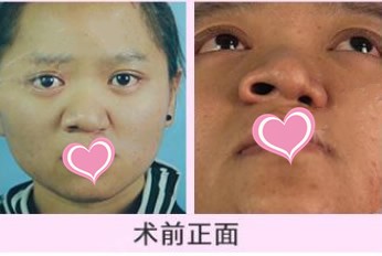 畸形鼻修復(fù)案例:鼻孔明顯不對稱的我做了肋軟骨鼻綜合后…