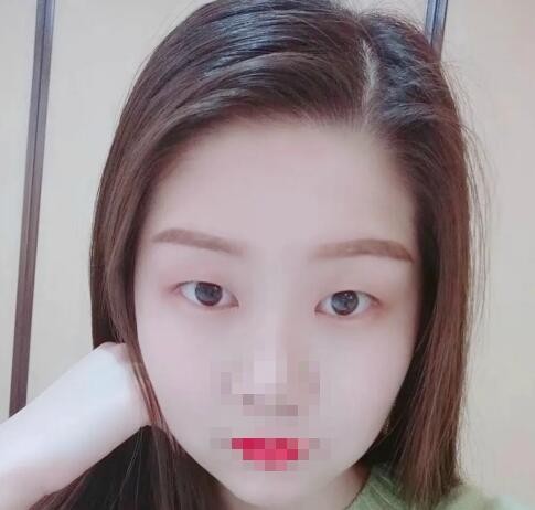 15000元做的眼綜合20天恢復(fù)圖,看我怎么從母胎單眼皮成功脫單