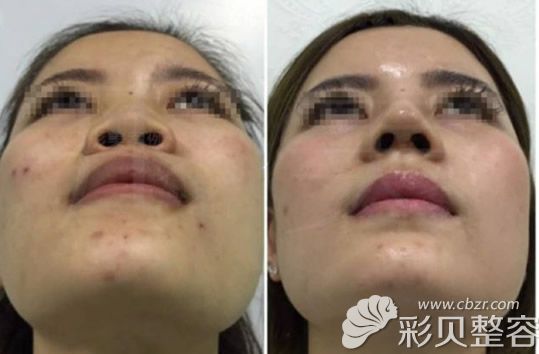 塌鼻子妹子做直挺鼻前后效果對比