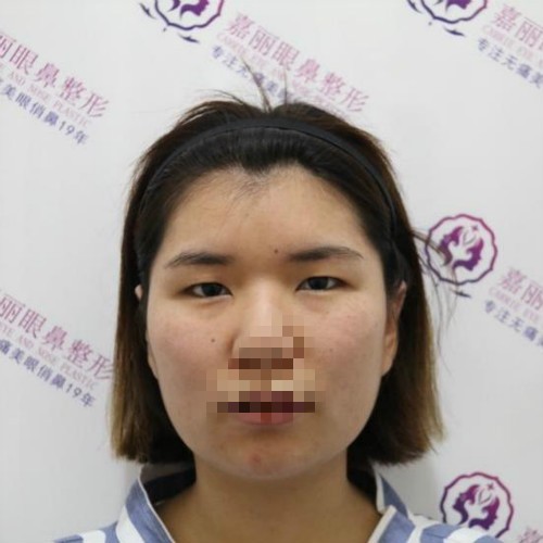 腫眼泡割雙眼皮真丑不可信!我肉眼泡割雙眼皮40天圖片作證