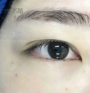 內(nèi)雙的人適合割雙眼皮還是埋線?請看內(nèi)雙做雙眼皮效果圖!