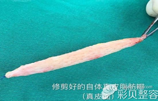 修剪好的自體真皮脂肪瓣 修剪好的自體真皮脂肪瓣