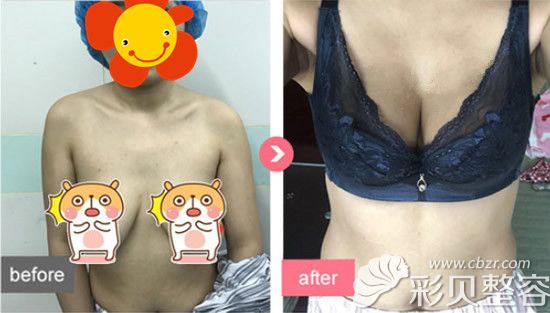 乳房上提手術(shù)效果能維持多久?分享我做人工韌帶提升術(shù)經(jīng)歷