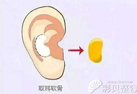 取耳軟骨圖 取耳軟骨圖