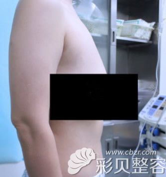 用的人工韌帶提胸后悔了,看我韌帶乳房提升失敗的手術(shù)經(jīng)歷!