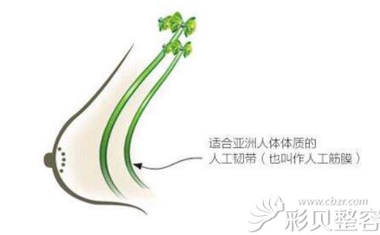 人工韌帶乳房提升 人工韌帶乳房提升