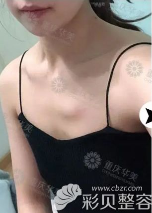 平胸的我做了假體隆胸后悔了!這假體隆胸